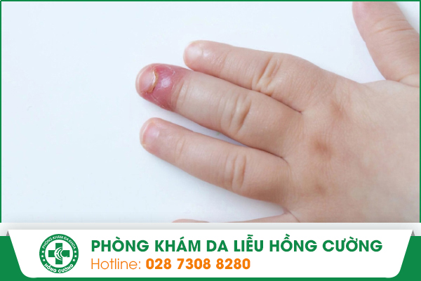 Những Nguy Hại Do Mắc Phải Bệnh Chín Mé