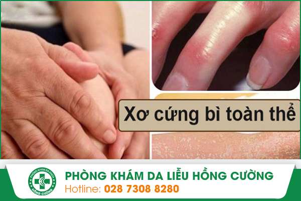 Bệnh Xơ Cứng Bì Toàn Thể Nguy Hiểm Như Thế Nào?