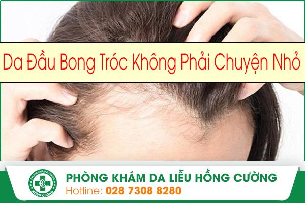 Da Đầu Bong Tróc Không Chỉ Đơn Giản Là Bị Gàu