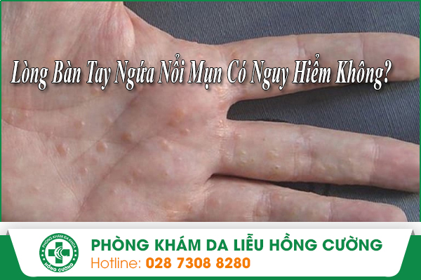 Lòng Bàn Tay Ngứa Nổi Hột Có Nguy Hiểm Không?