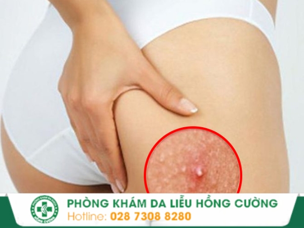 mụn viêm mông