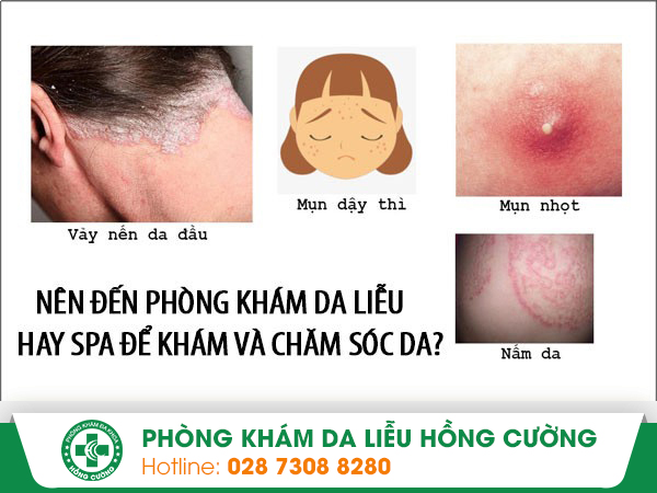 90% bệnh nhân lựa chọn khám và chăm sóc da ở phòng khám da liễu thay vì đến Spa