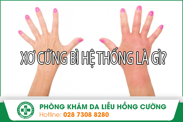 Bệnh Xơ Cứng Bì Hệ Thống Là Gì?