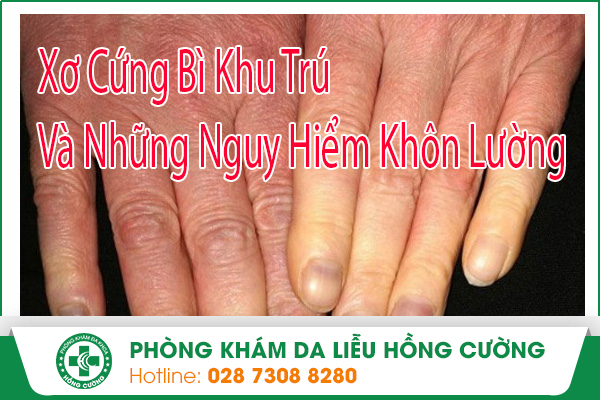 Xơ Cứng Bì Khu Trú Và Những Nguy Hiểm Khôn Lường